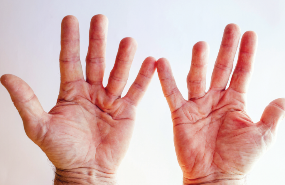 Maladie de Dupuytren