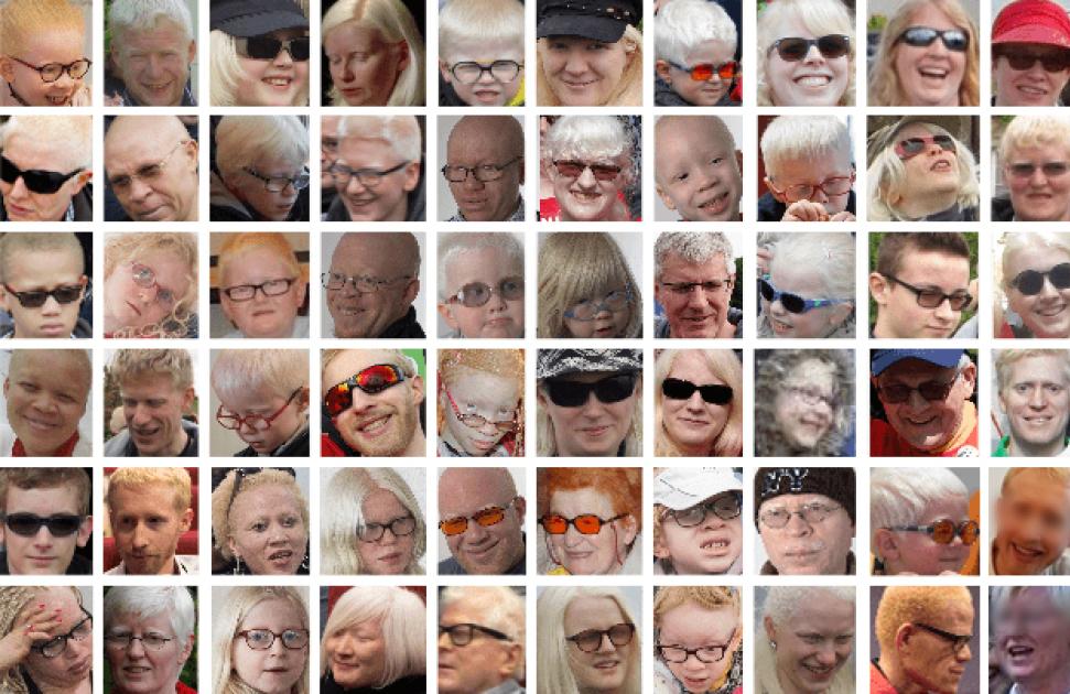 Genespoir.org : l'urgence de faire avancer la recherche sur l'albinisme