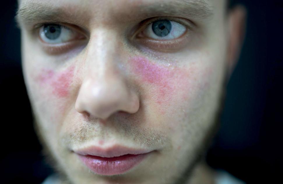 Lupus systémique : le lien avec le monde du travail