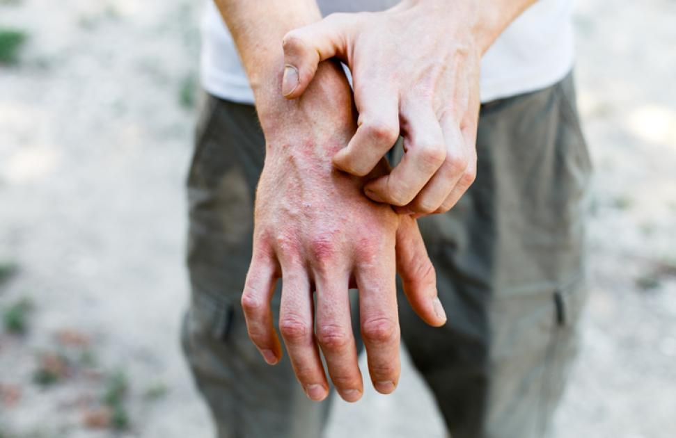 Association française de l'eczéma : lutter ensemble pour des patients à fleur de peau