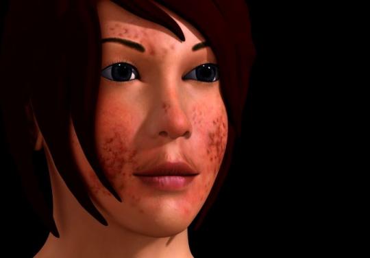 acné chez une adolescente