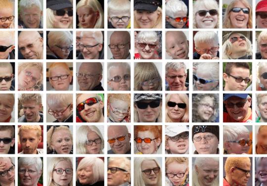 Genespoir.org : l'urgence de faire avancer la recherche sur l'albinisme