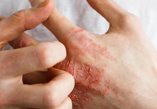 Dermatite Atopique : une nouvelle campagne "qui dit tout haut ce que la peau crie tout bas"